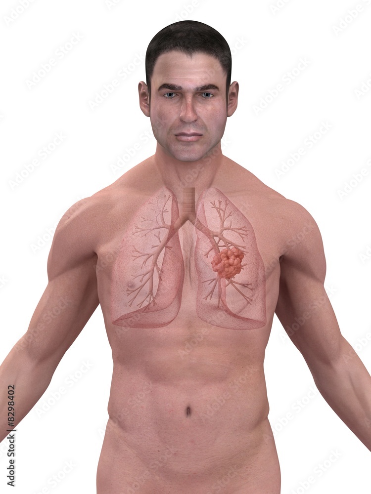 Fototapeta premium lungenkrebs