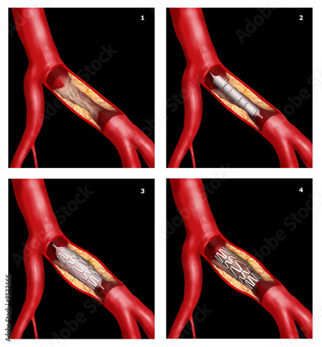 stent coronarico photo