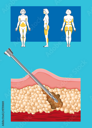 liposuction