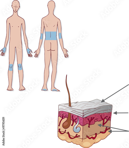 psoriasis