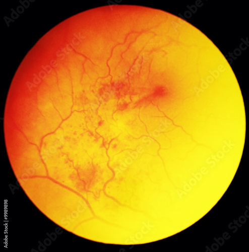 Eye under microscope examination - ischemic haemorrhage photo