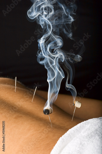 Patient receiving acupuncture treatment to his back