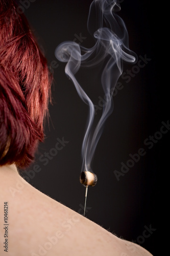 Schilderij op canvas Woman's shoulder with smoking moxa on acupuncture needle