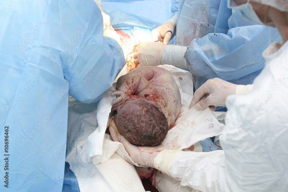 New baby being born during cesarean section