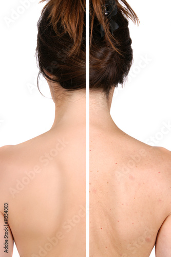 Left:  smooth skin after treatment - right  pimples  bad skin