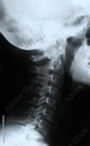 X ray of a neck