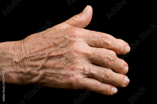 Old hand with arthritis © Xalanx