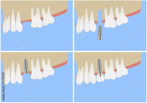 medical treatment by implant photo