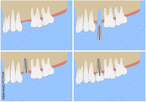 medical treatment by implant