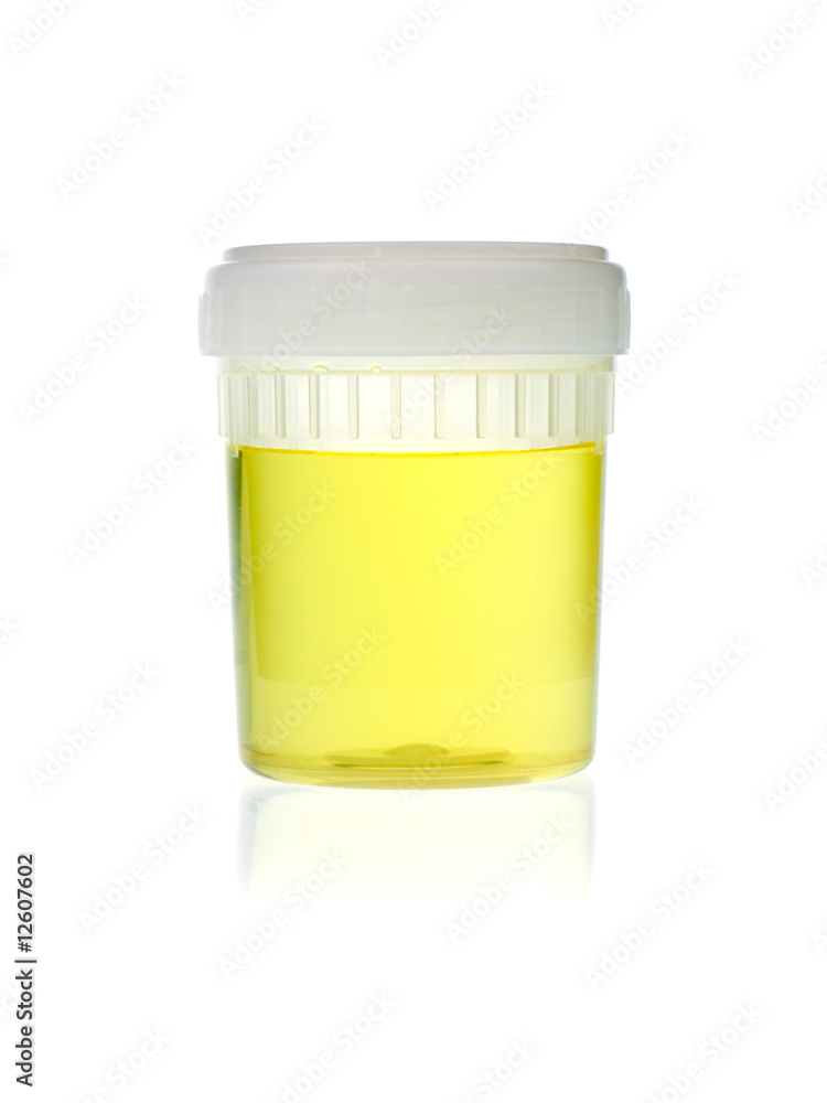 Urine analysis Urine analysis