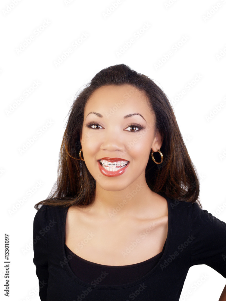 Young black woman smiling with braces on upper teeth Young black woman smiling with braces on upper teeth