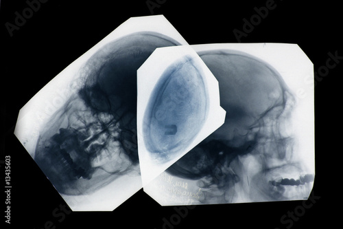 x-ray pictures of human skull in natural colors - positive