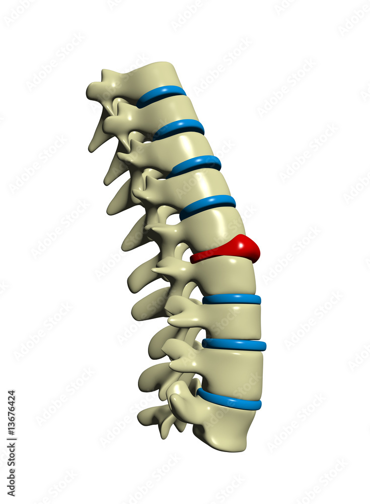 Spine with deformed spinal disc Stock Illustration | Adobe Stock