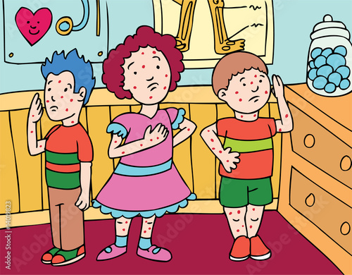 Chicken Pox