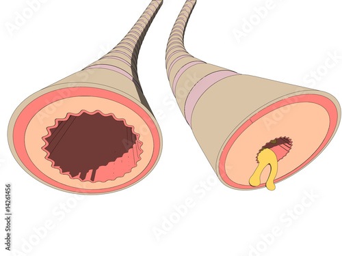 asthma bronchiales