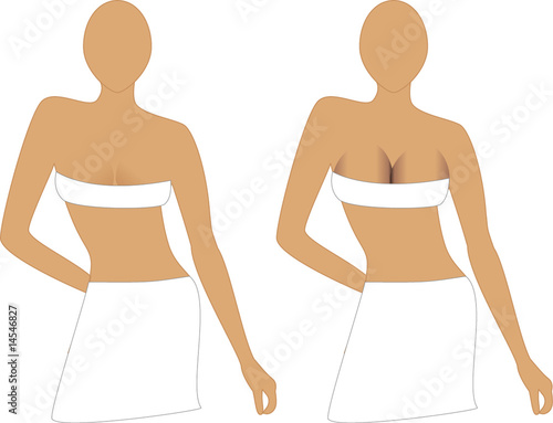 Before and After Breast Augmentation Implants.