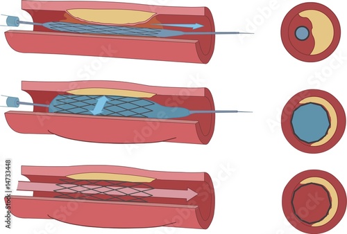 stent