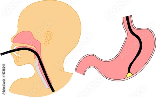 endoscopy
