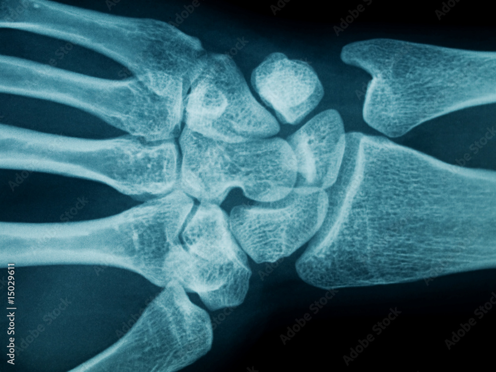 Hand wrist xray Stock Photo Adobe Stock