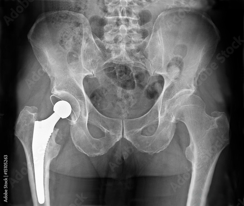 Radiographie Prothèse totale de hanche