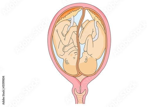 Unborn Twin Childs