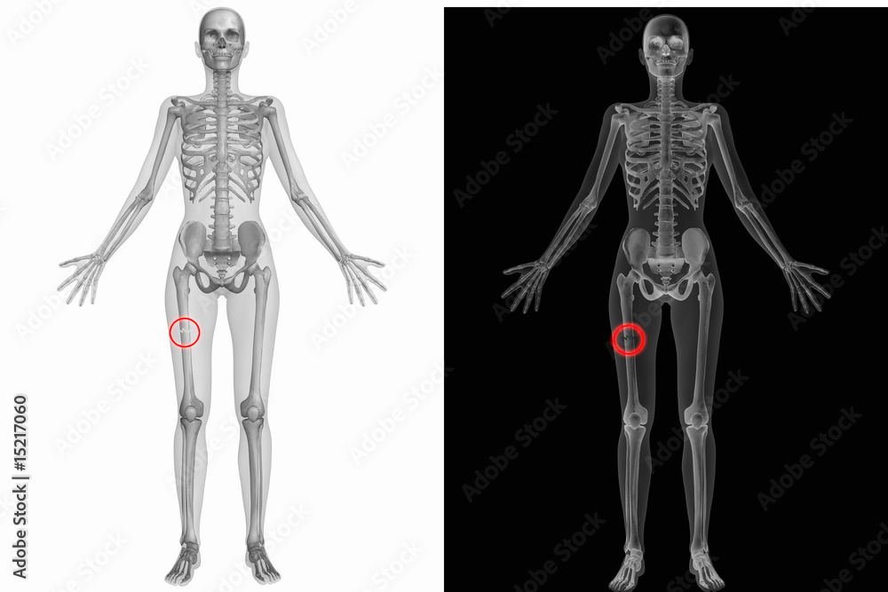 Anatomischer Körper mit gebrochenem Femur (Knochen) Anatomischer Körper mit gebrochenem Femur (Knochen)