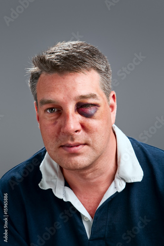 Male portrait with bruised eye
