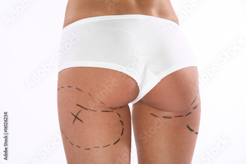 Photos Fesses chirurgie esthetique