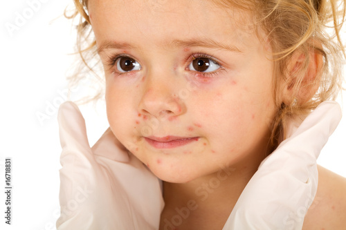 Obraz na plátně Little girl with small pox at the physician