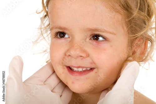 Foto Little girl with small pox at the doctors