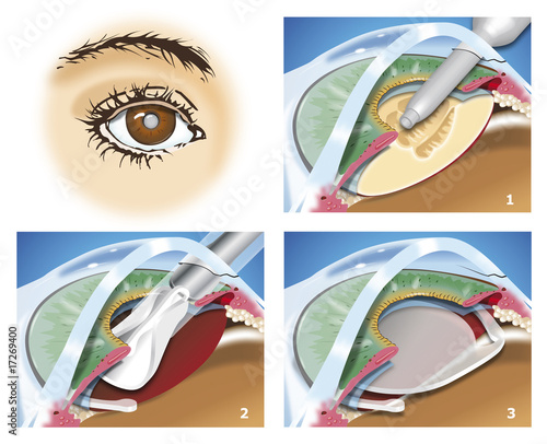 cataract photo