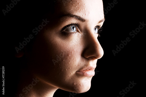 Female acne sufferer photo