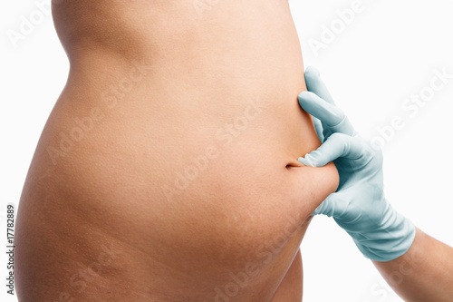 Female mid section pinched before liposuction