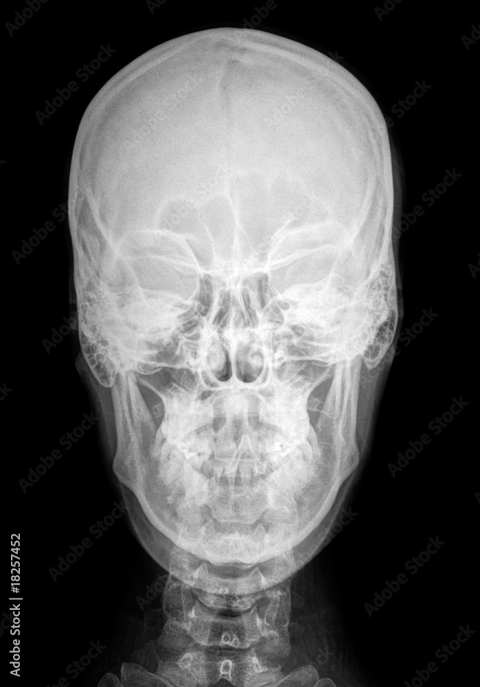 röntgenbild kopf frontal röntgenbild kopf frontal