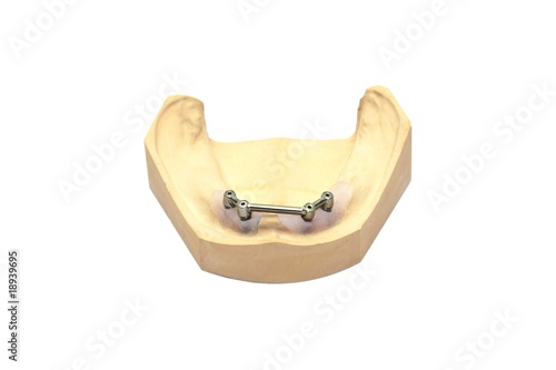 Dental Implantate Steg