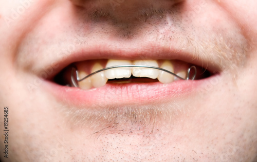 male with overbite wearing braces and smiling photo