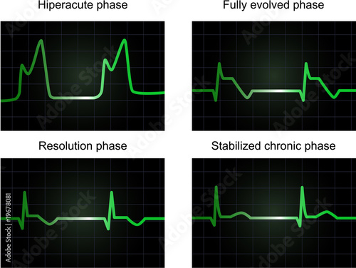 Processe of miocardial infarction on four phases, vector