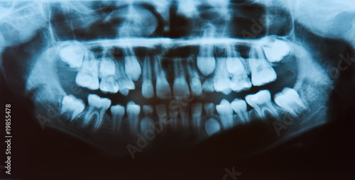 Panoramic dental X-Ray, all teeth in view.