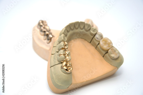 Zahnersatz -Teilkronen