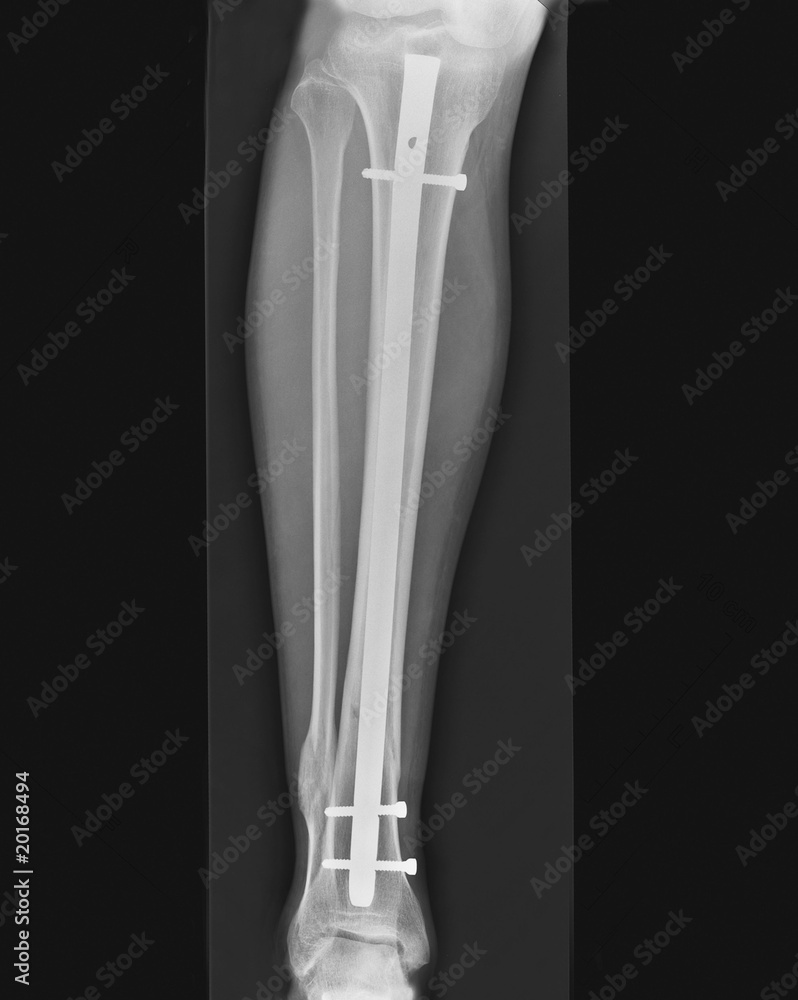 radio fracture de jambe enclouage radio fracture de jambe enclouage