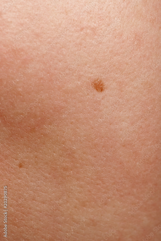 Close-up of human skin and mole Close-up of human skin and mole