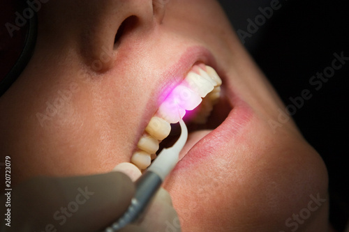 Dental Laser Zahnbehandlung Zahnfleisch photo