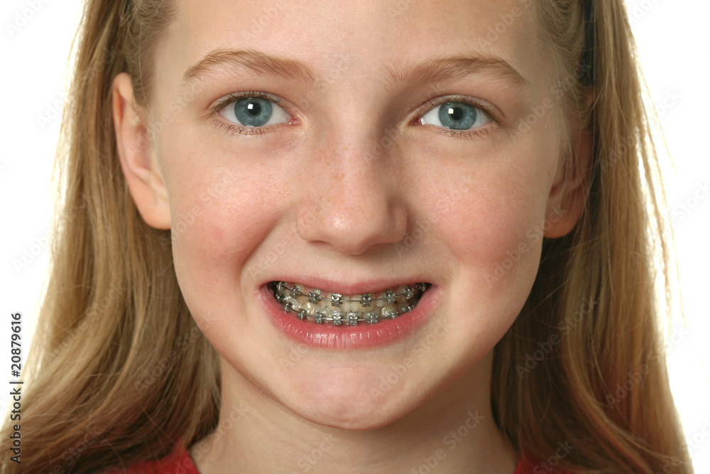 Fototapeta premium Dental Braces