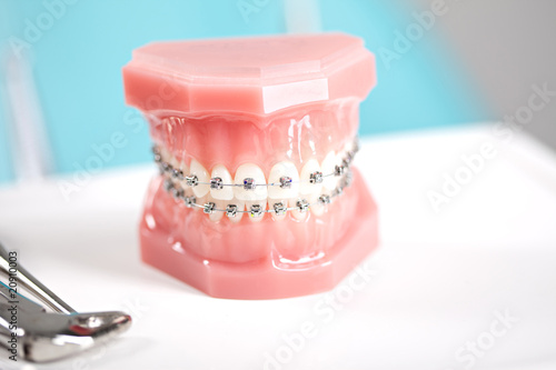 Braces