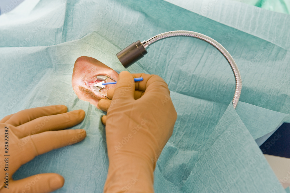 chirurgie réfractive Stock Photo Adobe Stock