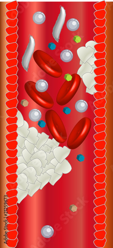 Herzinfarkt