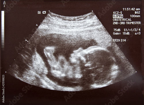 Valokuva Ultrasound during second trimester