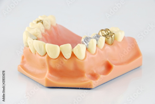 Dental model (with different treatments)