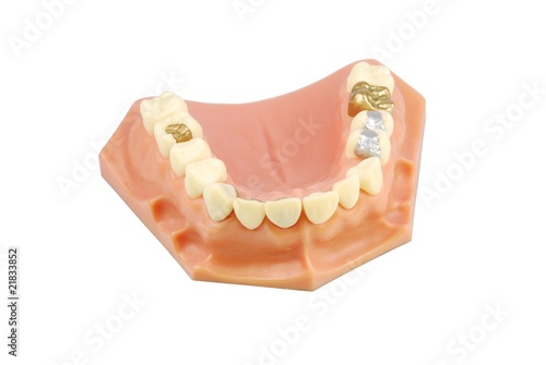 Dental model (with different treatments)