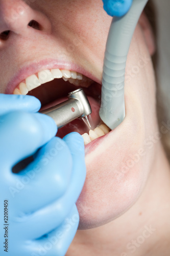 Caries treatment photo